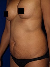 Tummy Tuck Before & After
