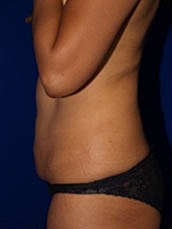 Tummy Tuck Before & After