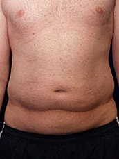 Tummy Tuck Before & After