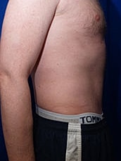 Tummy Tuck Before & After