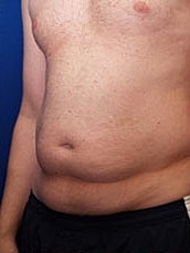 Tummy Tuck Before & After