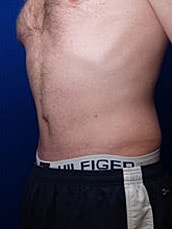 Tummy Tuck Before & After