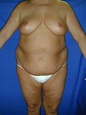 Tummy Tuck Before & After
