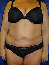 Tummy Tuck Before & After
