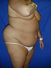 Tummy Tuck Before & After
