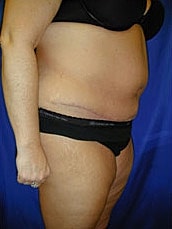 Tummy Tuck Before & After