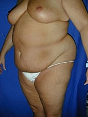 Tummy Tuck Before & After