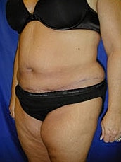 Tummy Tuck Before & After