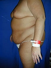 Tummy Tuck Before & After