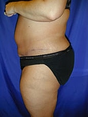 Tummy Tuck Before & After