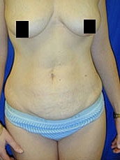 Tummy Tuck Before & After
