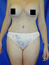 Tummy Tuck Before & After