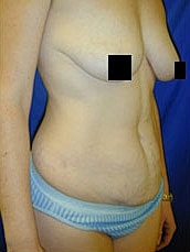 Tummy Tuck Before & After