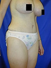 Tummy Tuck Before & After