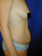 Tummy Tuck Before & After