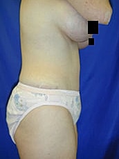 Tummy Tuck Before & After