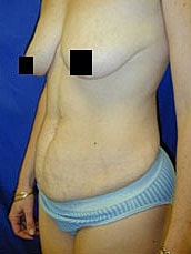 Tummy Tuck Before & After