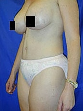 Tummy Tuck Before & After
