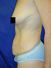 Tummy Tuck Before & After