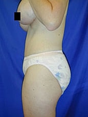 Tummy Tuck Before & After