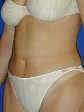 Tummy Tuck Before & After