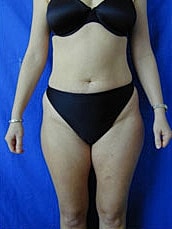 Tummy Tuck Before & After