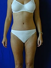 Tummy Tuck Before & After