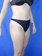 Tummy Tuck Before & After