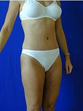 Tummy Tuck Before & After
