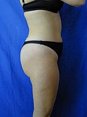 Tummy Tuck Before & After