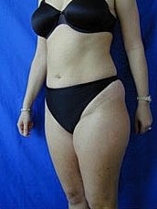 Tummy Tuck Before & After