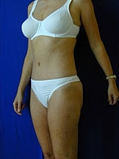 Tummy Tuck Before & After