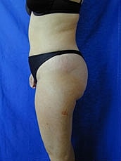 Tummy Tuck Before & After