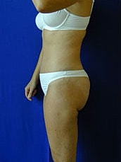 Tummy Tuck Before & After