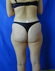 Tummy Tuck Before & After