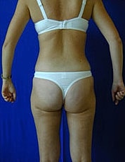 Tummy Tuck Before & After