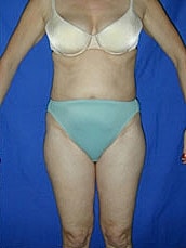 Tummy Tuck Before & After