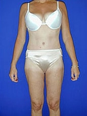Tummy Tuck Before & After