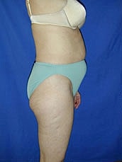 Tummy Tuck Before & After
