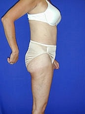 Tummy Tuck Before & After