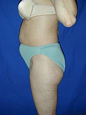 Tummy Tuck Before & After