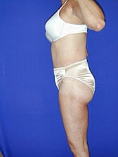 Tummy Tuck Before & After