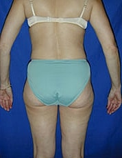 Tummy Tuck Before & After