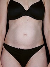 Tummy Tuck Before & After