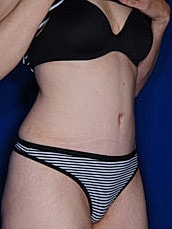 Tummy Tuck Before & After