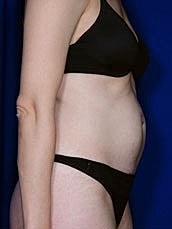 Tummy Tuck Before & After