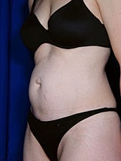 Tummy Tuck Before & After