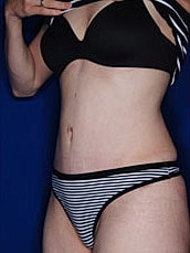 Tummy Tuck Before & After