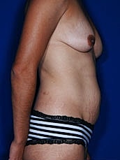 Tummy Tuck Before & After