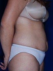 Tummy Tuck Before & After